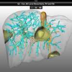Une tablette tactile (iPad) pour opérer un cancer du foie : une première dans l’histoire de la médecine ! 1